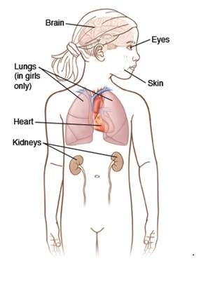 Possible tumors TSC patient