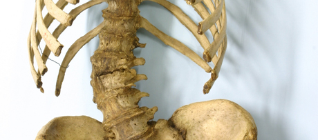 Wervelkolom met scolioseSpinal column with scoliosis