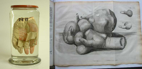Links een zogenaamd nat preparaat van een hand, rechts een afbeelding in het boek "Geneeskundige en heelkundige werken" door F. Ruysch, 1744