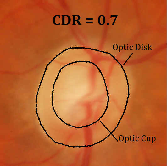 Glaucoma damages the optic nerve irreversibly and has no early symptoms. It is ranked second as a cause of blindness. We ((J. Guo, C. Shi, prof. N. Jansonius, prof. N. Petkov) develop computer methods to be used in screening for glaucoma. Contact: prof. N. Petkov.