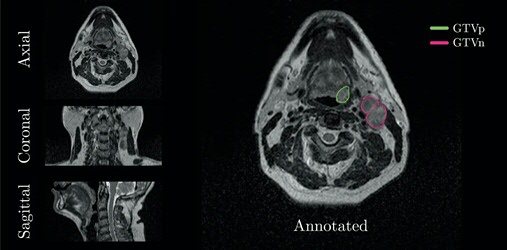 Tumor segmentation