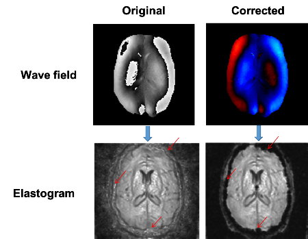 In the original MR Elastography measurement (upper left panel), the wave field presents some artifacts (the sudden changes from light to dark and vice versa). Using the new approach (upper right panel) these artifacts are no longer present. These wave fields can be converted into stiffness maps or “elastograms” (lower panels). The elastogram using the original measurement shows tissue where it is not actually present (red arrows), as can be seen on the elastograms made using the improved method. | Illustration C. Bertoglio, University of Groningen