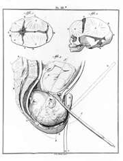 A device used to assist birthing, drawn by Camper