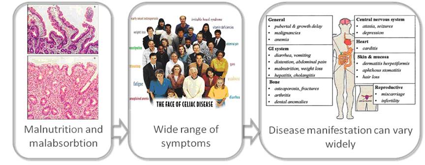 The wide-ranging effects of coeliac disease